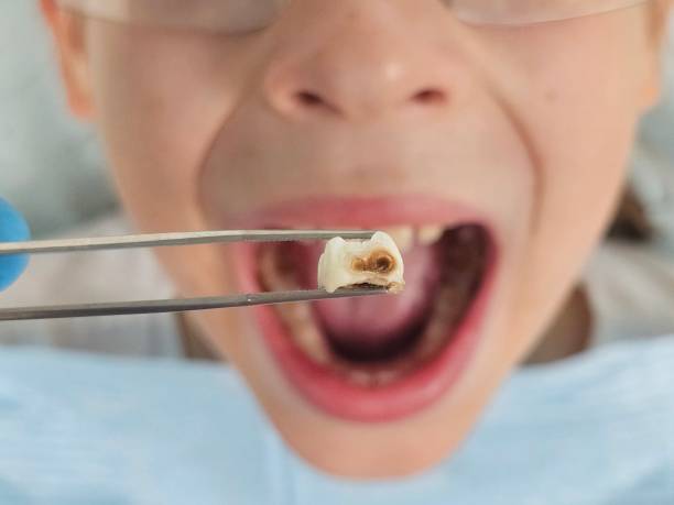 Best Emergency Root Canal Treatment in Hamburg, AR